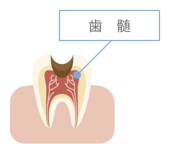 神経に進行したむし歯 イメージ